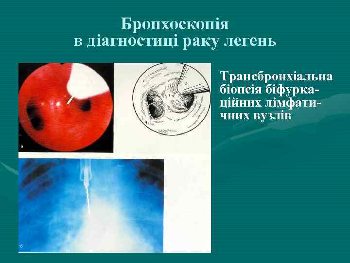 Бронхоскопія в діагностиці раку легень Трансбронхіальна біопсія біфуркаційних лімфатичних вузлів 