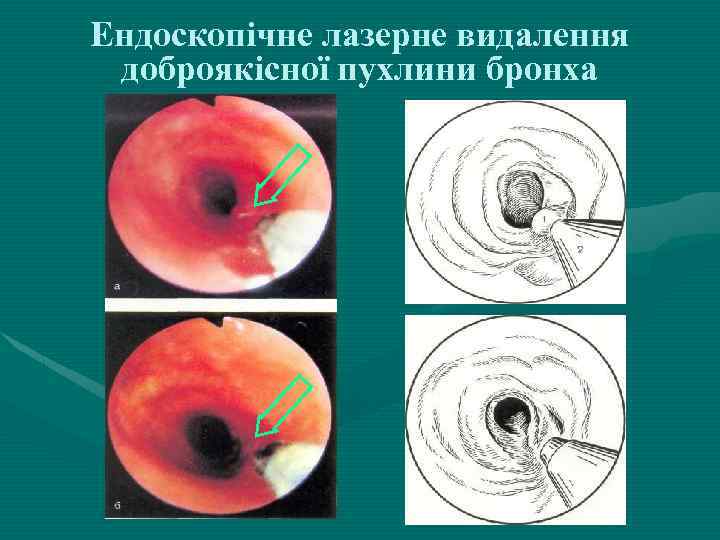 Ендоскопічне лазерне видалення доброякісної пухлини бронха 