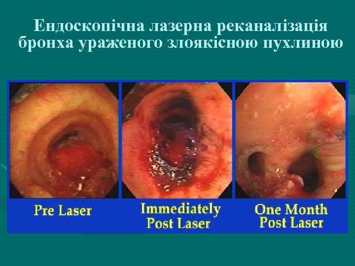 Ендоскопічна лазерна реканалізація бронха ураженого злоякісною пухлиною 