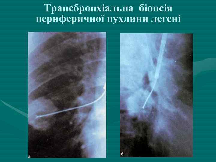 Трансбронхіальна біопсія периферичної пухлини легені 