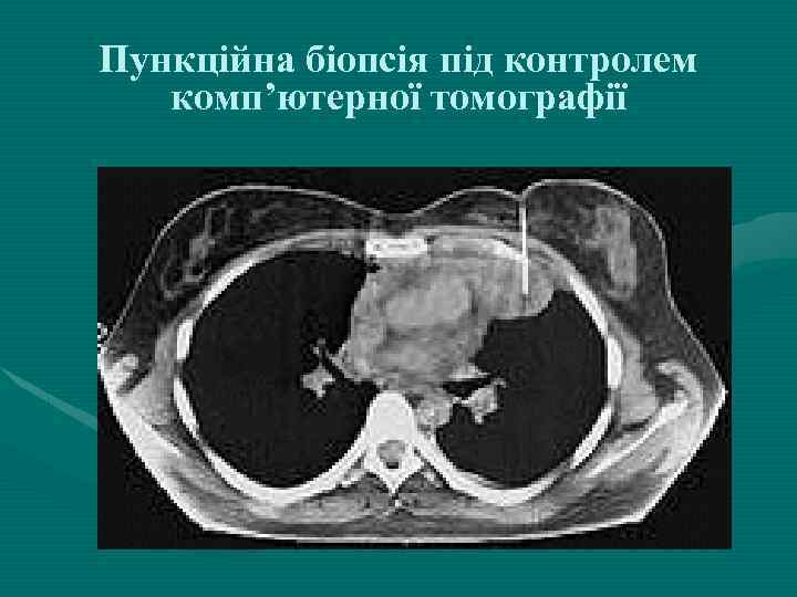 Пункційна біопсія під контролем комп’ютерної томографії 