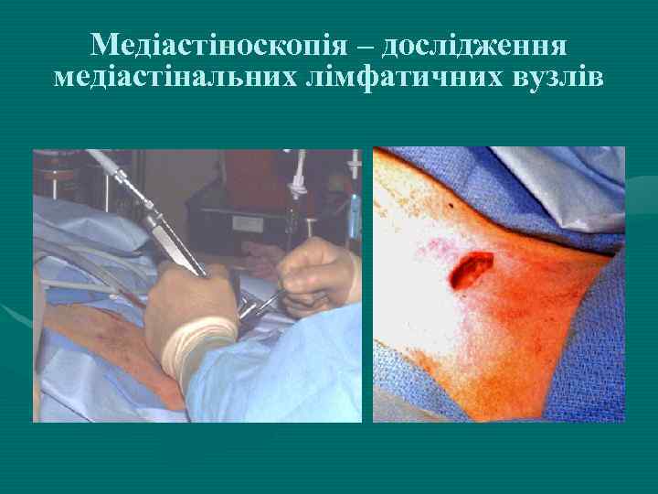 Медіастіноскопія – дослідження медіастінальних лімфатичних вузлів 