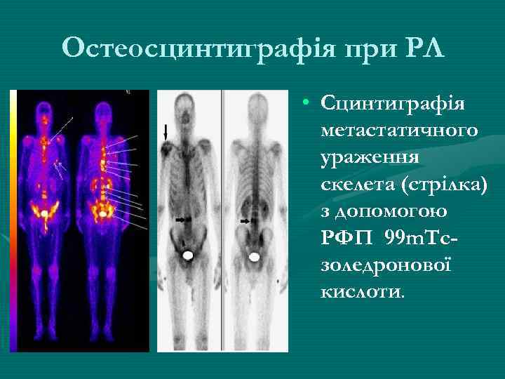 Остеосцинтиграфія при РЛ • Сцинтиграфія метастатичного ураження скелета (стрілка) з допомогою РФП 99 m.