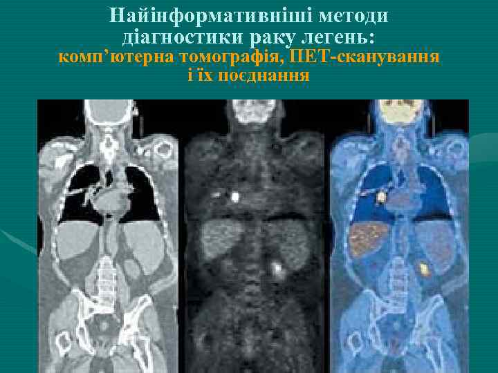 Найінформативніші методи діагностики раку легень: комп’ютерна томографія, ПЕТ-сканування і їх поєднання 
