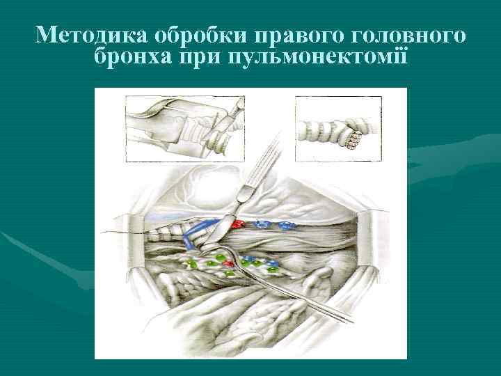 Методика обробки правого головного бронха при пульмонектомії 
