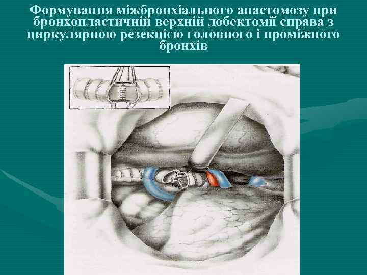 Формування міжбронхіального анастомозу при бронхопластичній верхній лобектомії справа з циркулярною резекцією головного і проміжного