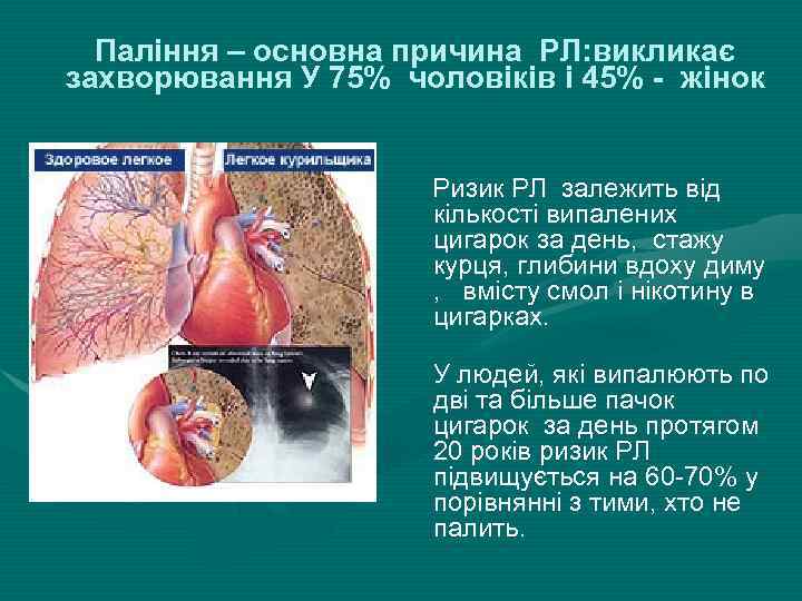 Паління – основна причина РЛ: викликає захворювання У 75% чоловіків і 45% - жінок