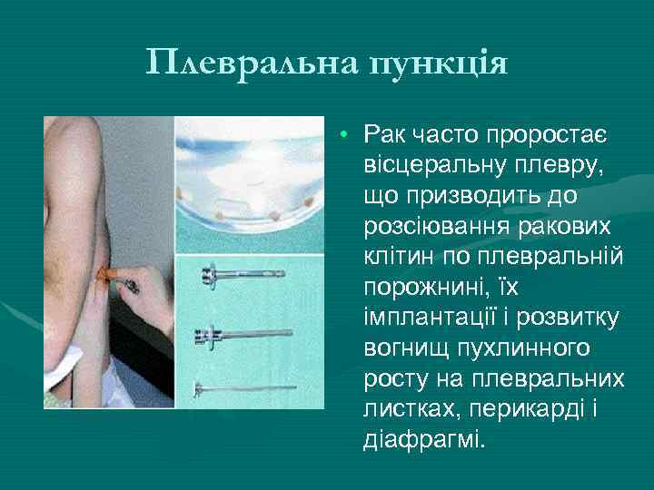 Плевральна пункція • Рак часто проростає вісцеральну плевру, що призводить до розсіювання ракових клітин
