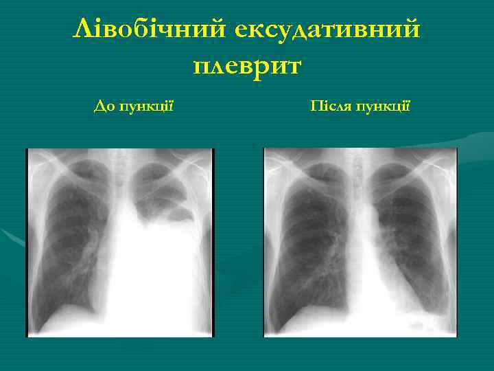Лівобічний ексудативний плеврит До пункції Після пункції 