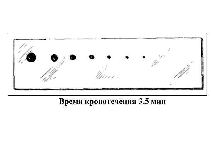 Время кровотечения 3, 5 мин 