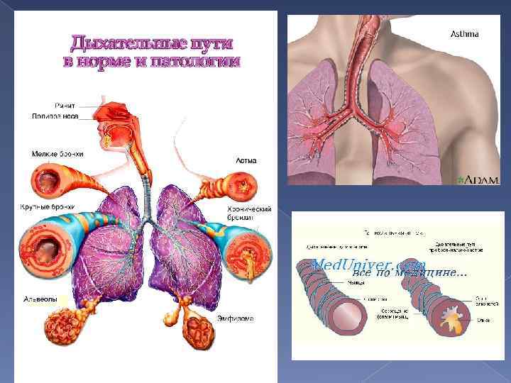 Бронхиальная астма презентация с картинками