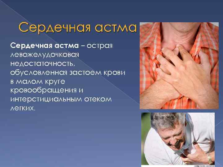 Сердечная астма – острая левожелудочковая недостаточность, обусловленная застоем крови в малом круге кровообращения и