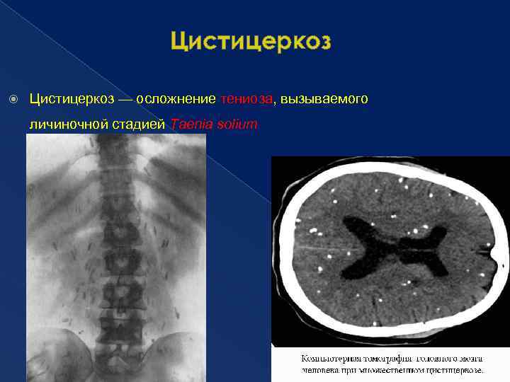 Цистицеркоз — осложнение тениоза, вызываемого личиночной стадией Taenia solium 