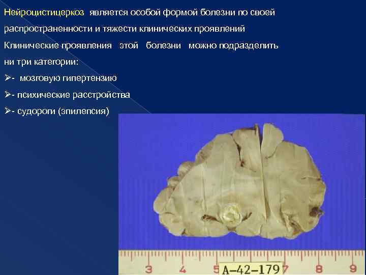 Нейроцистицеркоз является особой формой болезни по своей распространенности и тяжести клинических проявлений Клинические проявления