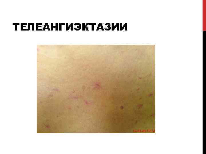 ТЕЛЕАНГИЭКТАЗИИ 