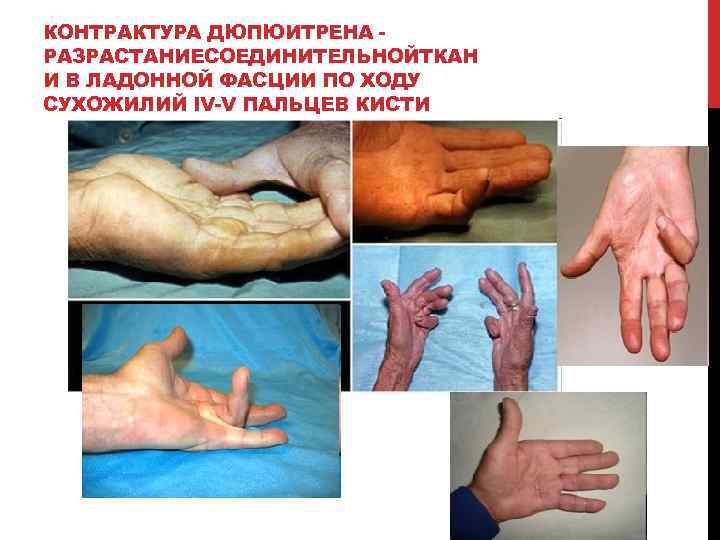 КОНТРАКТУРА ДЮПЮИТРЕНА РАЗРАСТАНИЕСОЕДИНИТЕЛЬНОЙТКАН И В ЛАДОННОЙ ФАСЦИИ ПО ХОДУ СУХОЖИЛИЙ IV-V ПАЛЬЦЕВ КИСТИ 