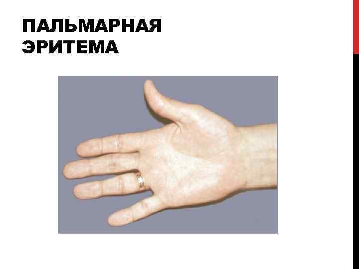 ПАЛЬМАРНАЯ ЭРИТЕМА 