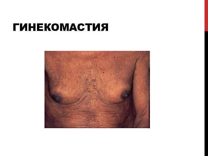 ГИНЕКОМАСТИЯ 