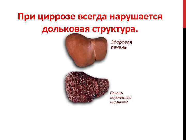 При циррозе всегда нарушается дольковая структура. 