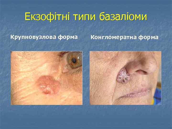 Екзофітні типи базаліоми Крупновузлова форма Конгломератна форма 