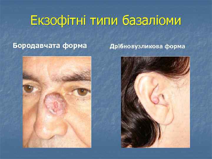Екзофітні типи базаліоми Бородавчата форма Дрібновузликова форма 