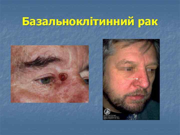 Базальноклітинний рак 