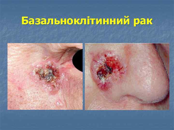 Базальноклітинний рак 