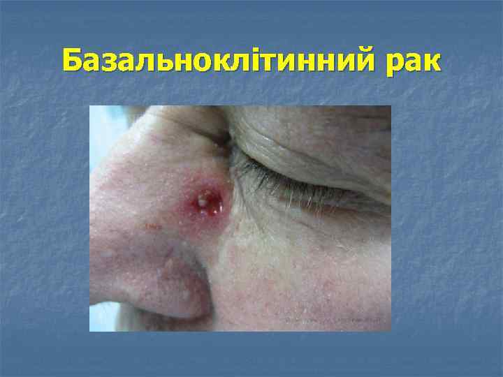 Базальноклітинний рак 