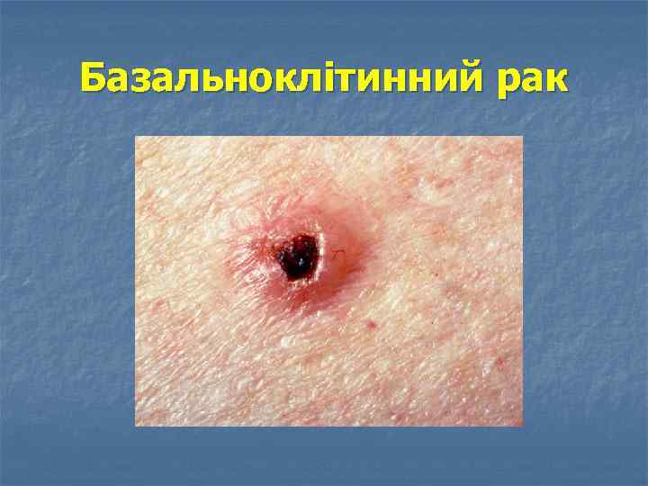 Базальноклітинний рак 