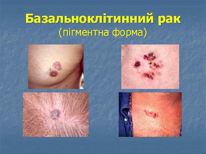 Базальноклітинний рак (пігментна форма) 