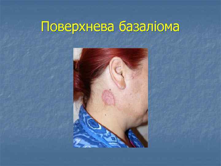 Поверхнева базаліома 