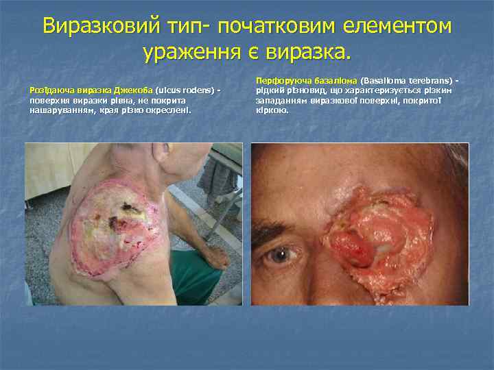 Виразковий тип початковим елементом ураження є виразка. Розїдаюча виразка Джекоба (ulcus rоdеns) поверхня виразки