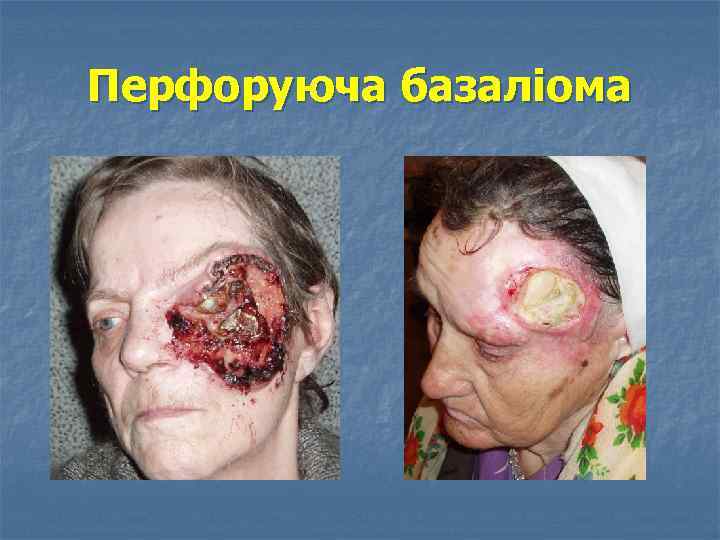 Перфоруюча базаліома 
