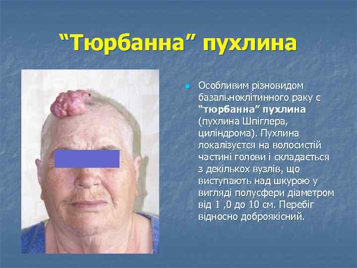 “Тюрбанна” пухлина n Особливим різновидом базальноклітинного раку є “тюрбанна” пухлина (пухлина Шпіглера, циліндрома). Пухлина