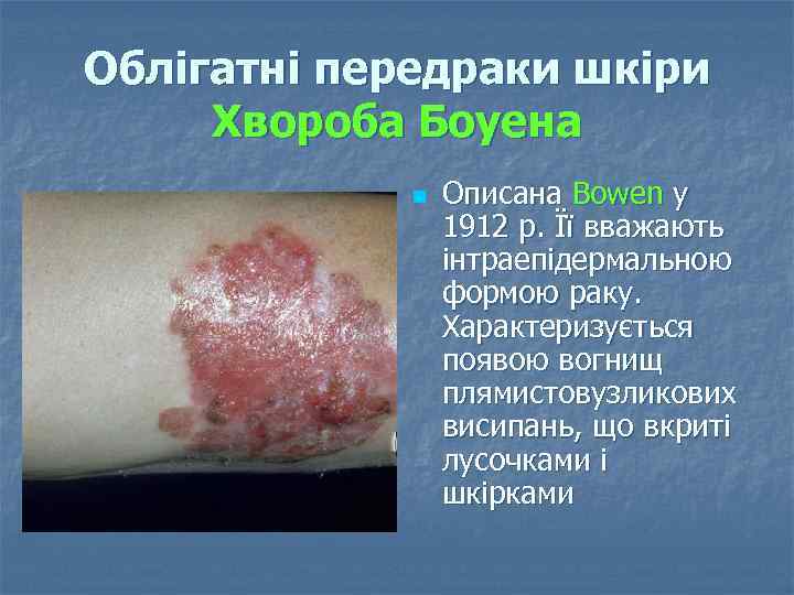 Облігатні передраки шкіри Хвороба Боуена n Описана Bowen у 1912 р. Її вважають інтраепідермальною