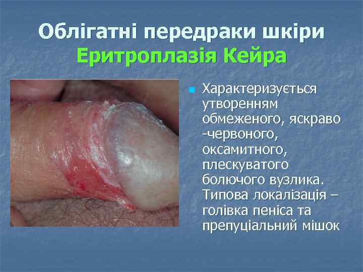 Облігатні передраки шкіри Еритроплазія Кейра n Характеризується утворенням обмеженого, яскраво червоного, оксамитного, плескуватого болючого