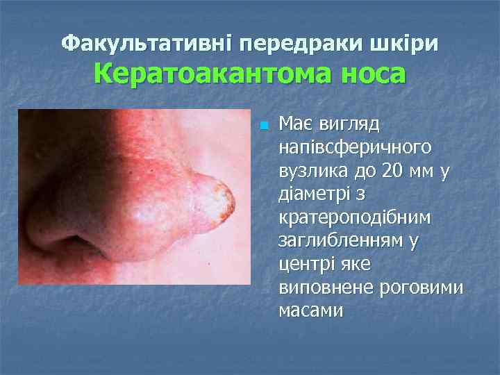 Факультативні передраки шкіри Кератоакантома носа n Має вигляд напівсферичного вузлика до 20 мм у