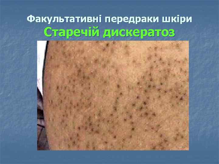 Факультативні передраки шкіри Старечій дискератоз 