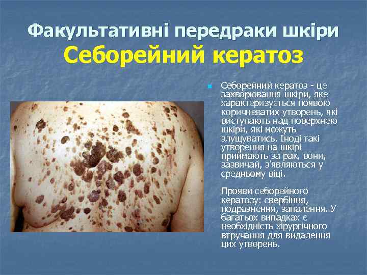 Факультативні передраки шкіри Себорейний кератоз n Себорейний кератоз це захворювання шкіри, яке характеризується появою