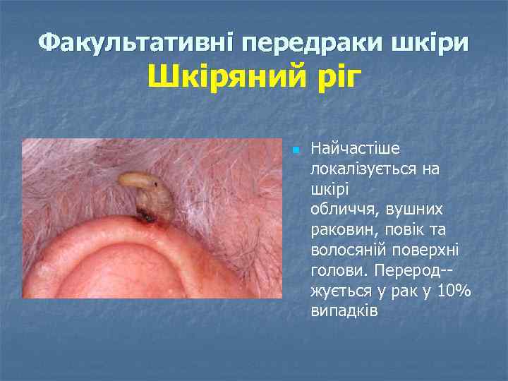 Факультативні передраки шкіри Шкіряний ріг n Найчастіше локалізується на шкірі обличчя, вушних раковин, повік