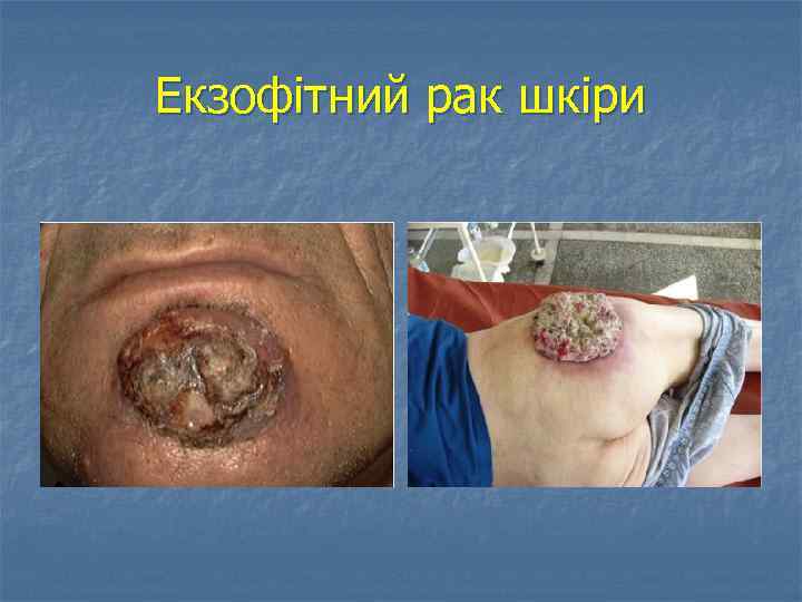 Екзофітний рак шкіри 