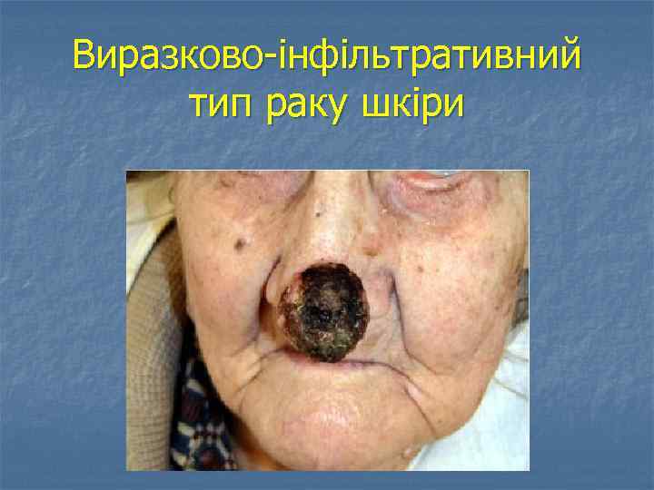 Виразково інфільтративний тип раку шкіри 
