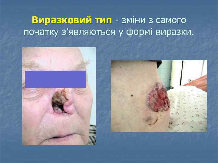 Виразковий тип зміни з самого початку з’являються у формі виразки. 