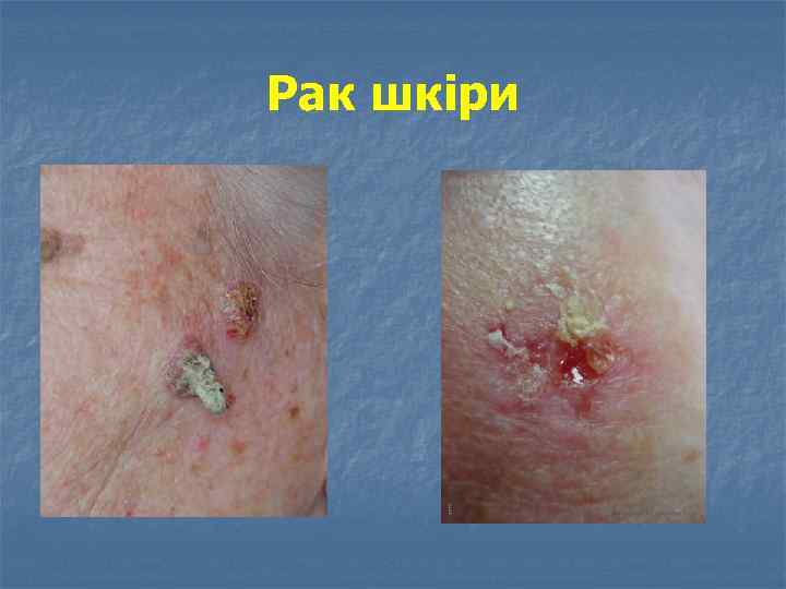 Рак шкіри 