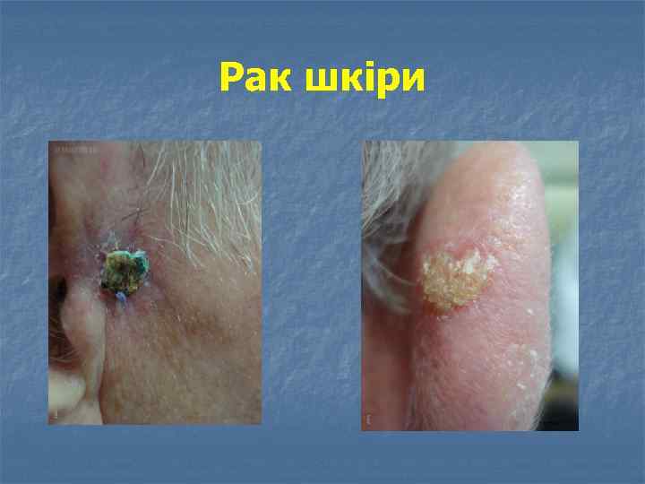 Рак шкіри 