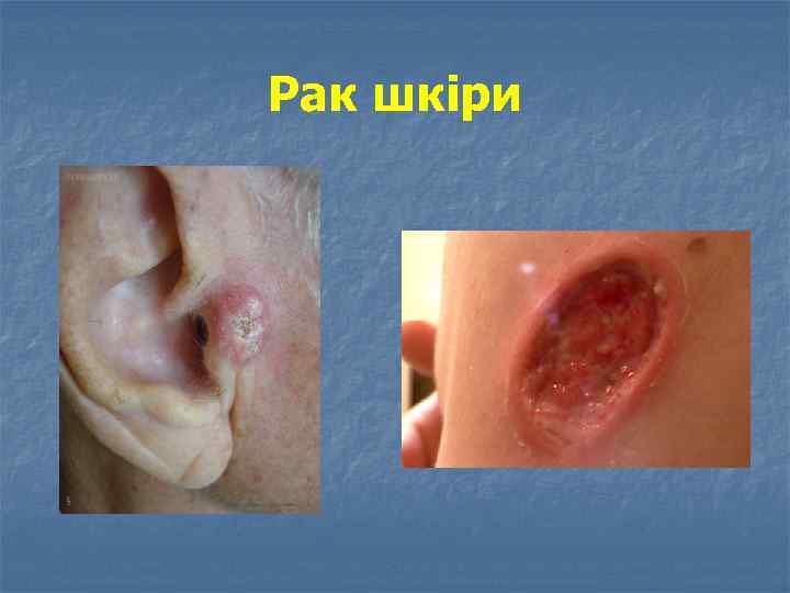 Рак шкіри 