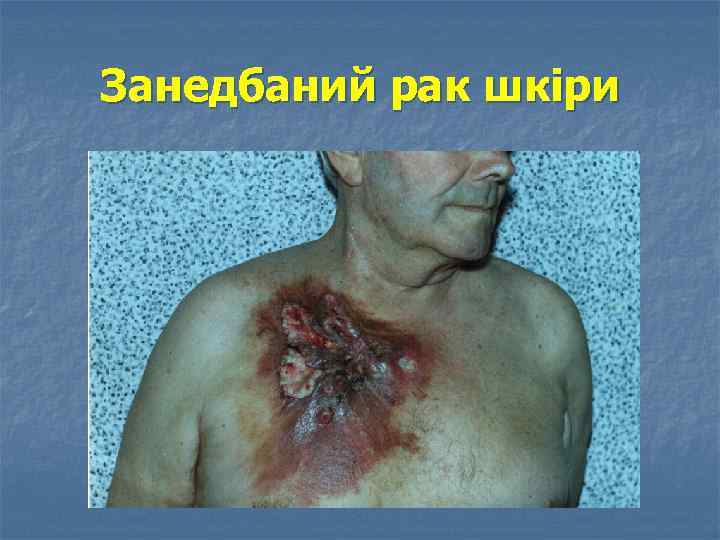Занедбаний рак шкіри 