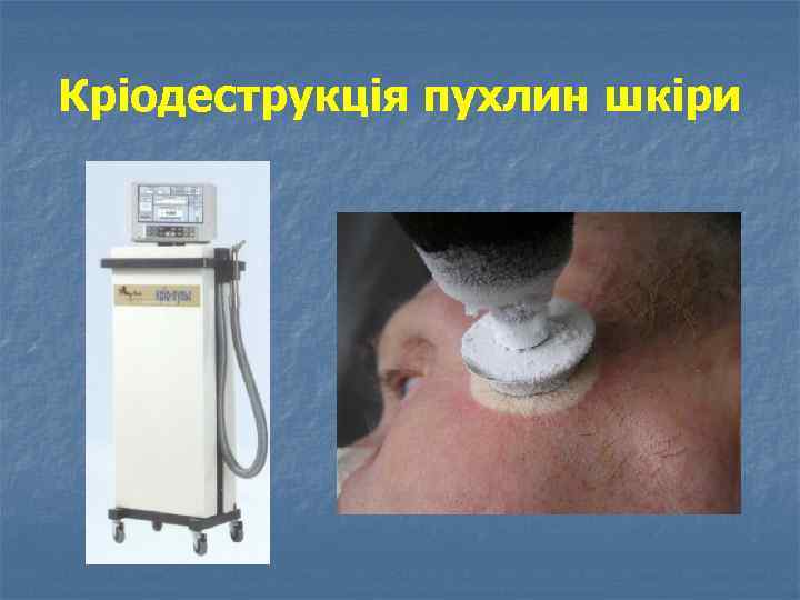 Кріодеструкція пухлин шкіри 