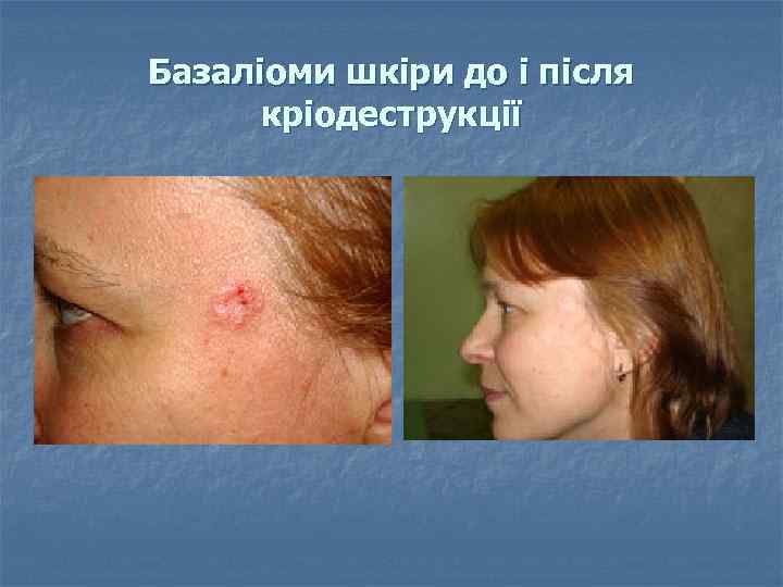 Базаліоми шкіри до і після кріодеструкції 