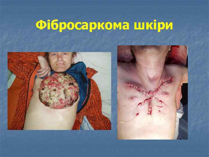 Фібросаркома шкіри 
